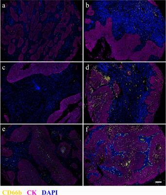 Stromal Neutrophil Extracellular Trap Density Is an Independent Prognostic Factor for Cervical Cancer Recurrence